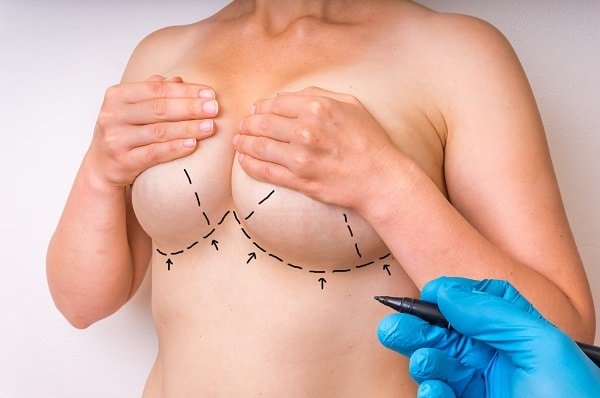doctor,makes,dotted,lines,on,female,body,for,cosmetic,surgery