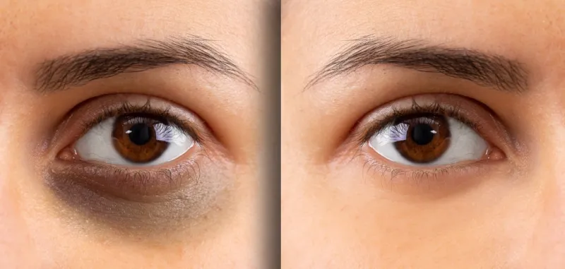 dark eyes laser treatment