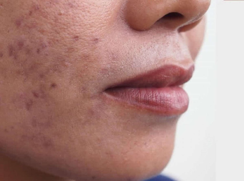 hyperpigmentation 1200x900 1