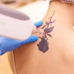 laser tattoo removal 11 04 2023 13 04 14