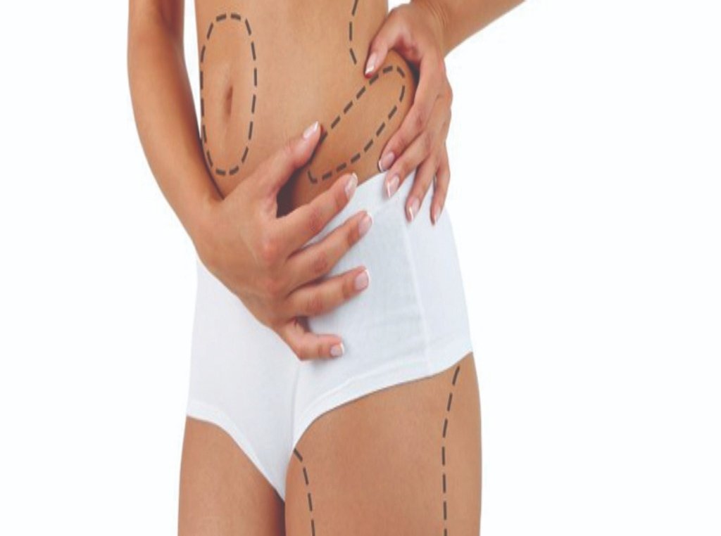 liposuction 2