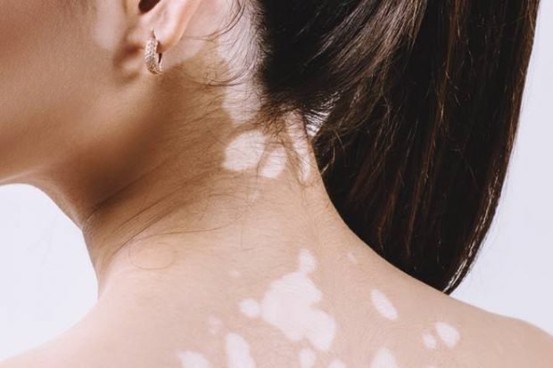 vitiligo 660 620x413