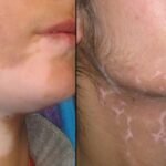 vitiligo treatment in gandhinagar 1024x568