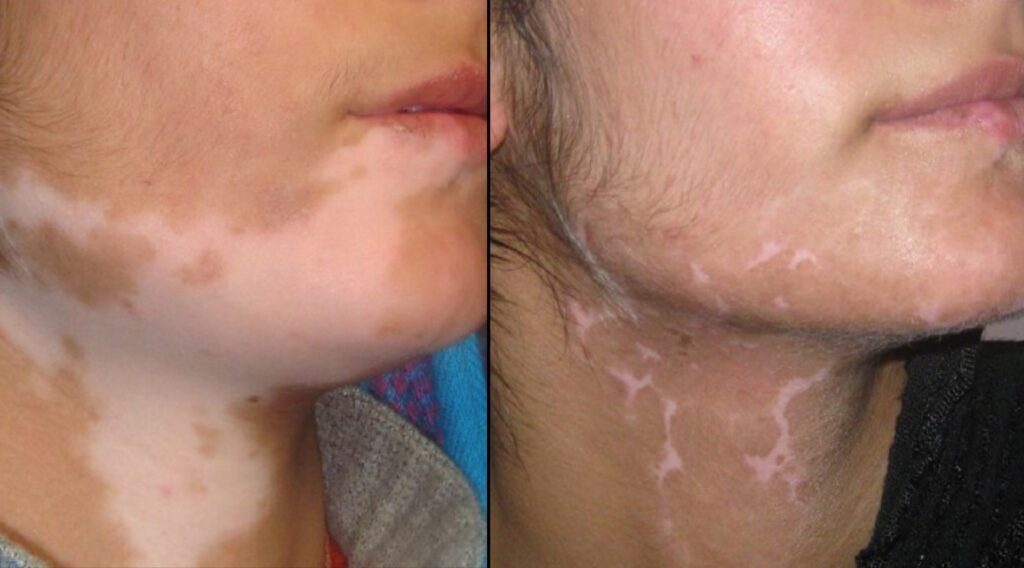vitiligo treatment in gandhinagar 1024x568