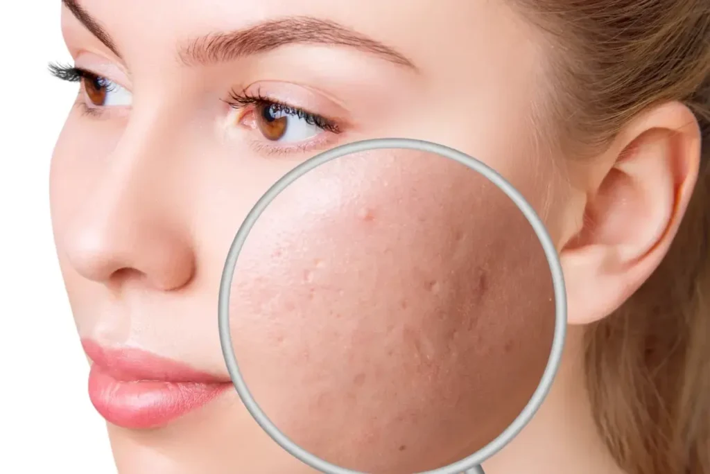 acne scar treatment amin