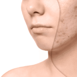 acne scars