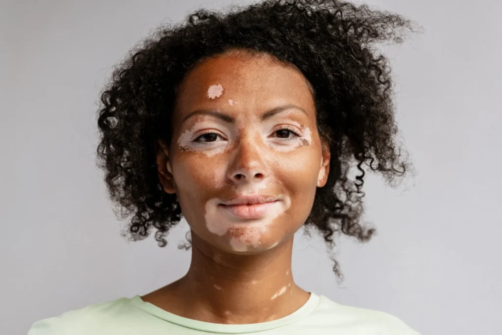 african american woman vitiligo face 1