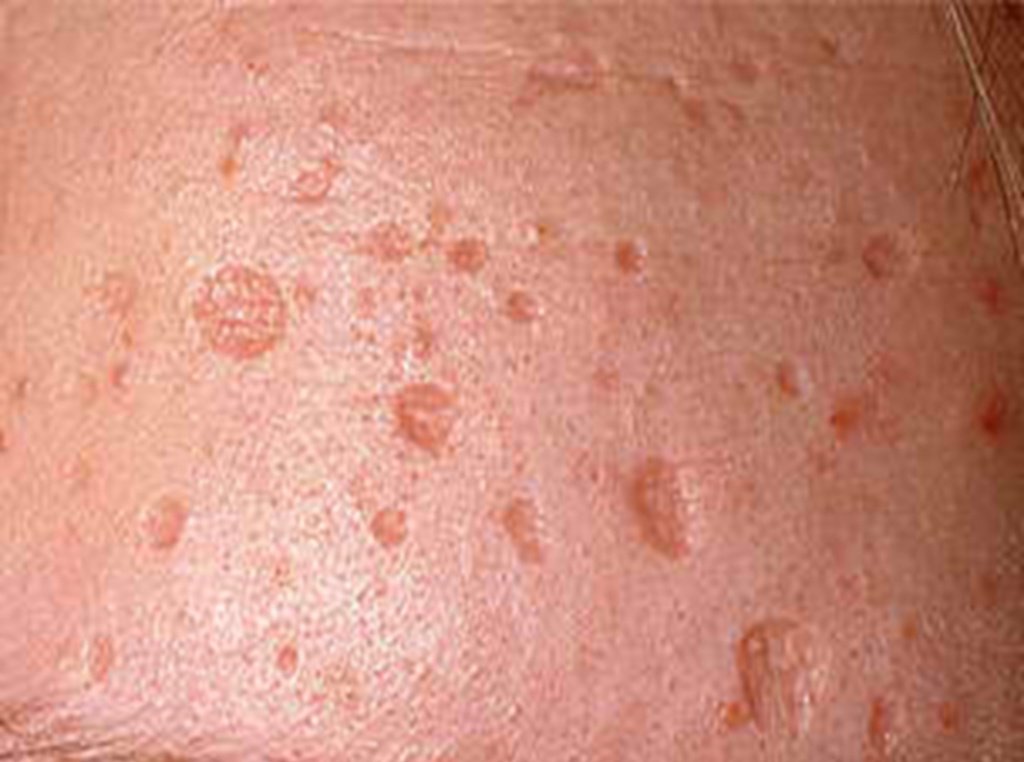 chickenpox scars