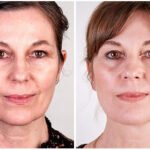 facelift