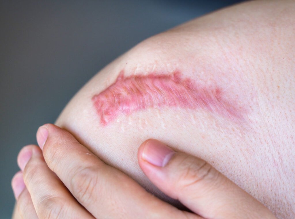 keloid,scar,after,bone,operation,at,shoulder,of,a,man.