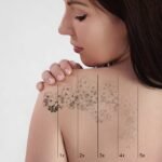 laser,tattoo,removal,on,woman's,shoulder.,medical,treatment