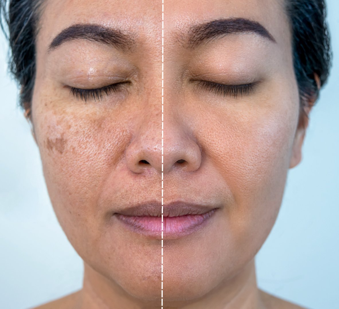 melasma