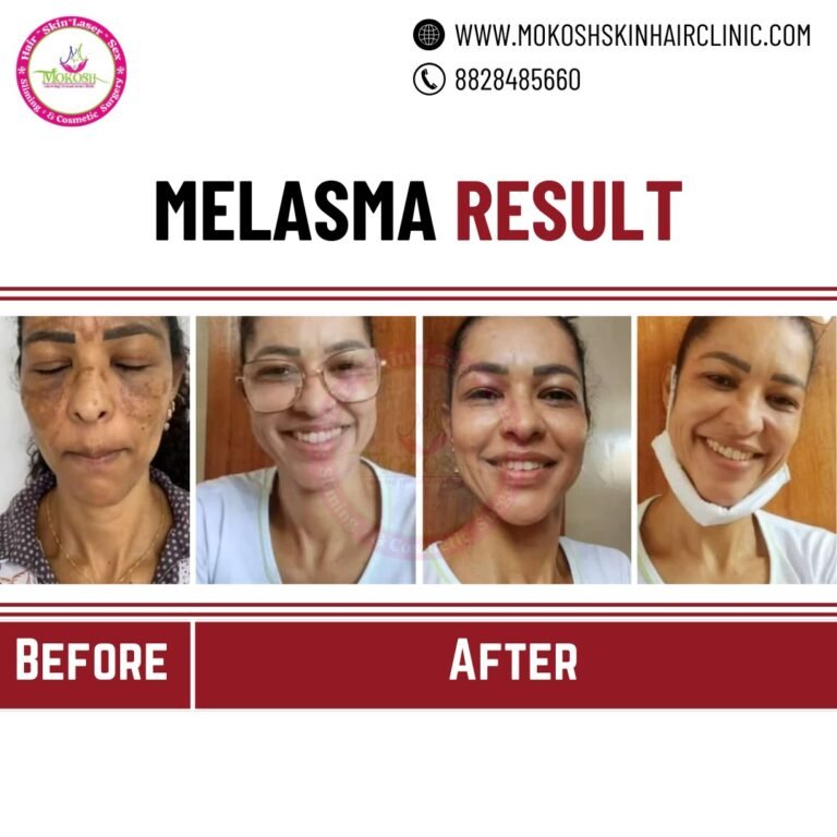 melasma1