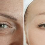 microneedling under eyes proneedling us