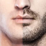 pg beard transplant img