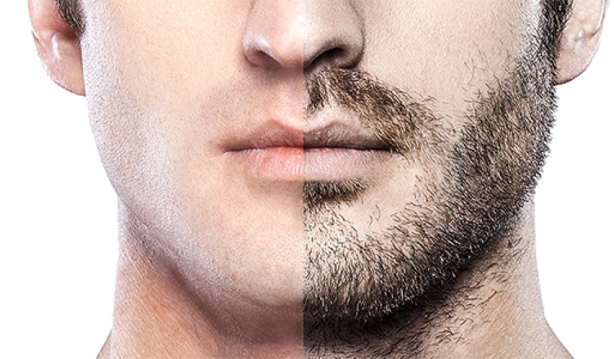 pg beard transplant img