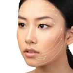 treatment es facelift 768x512