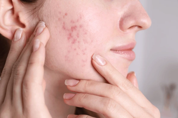 woman acne problem home closeup 600nw 2446165853